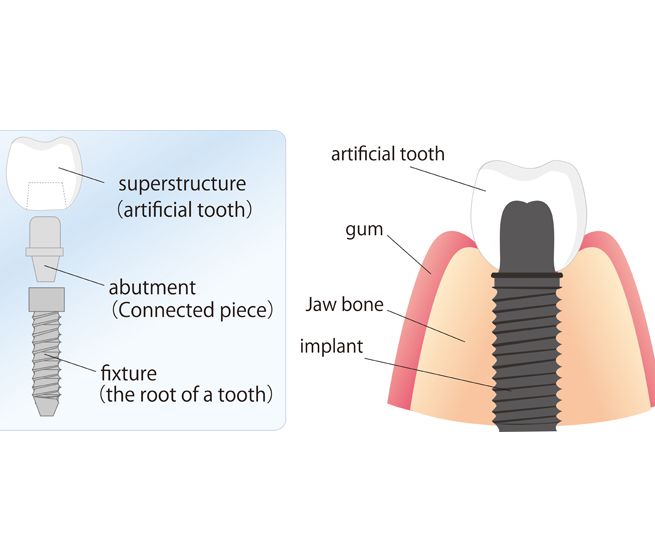 Dental implants Hampshire